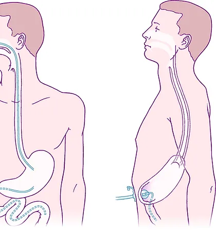 Endoskopik Perkütan Gastrostomi